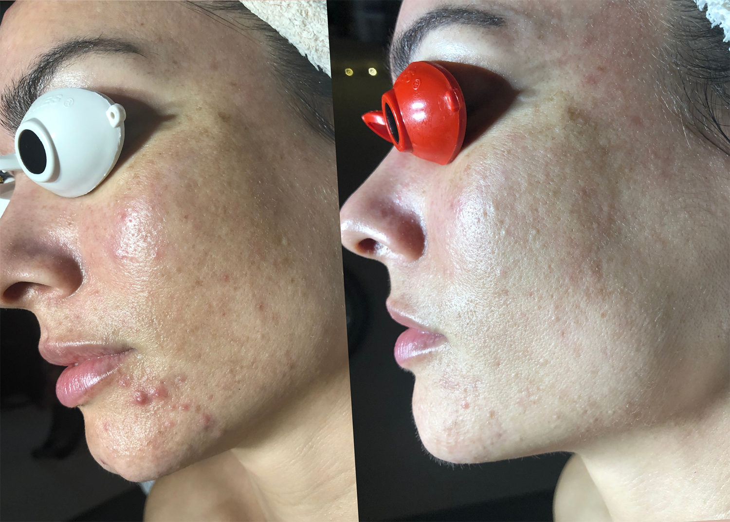 9. Pigment Correction + Acne Clearing (2)