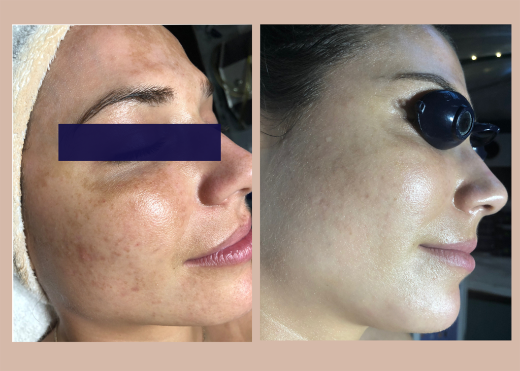 9.6 SBB - 4 month comprehensive program- Pigment Correction copy