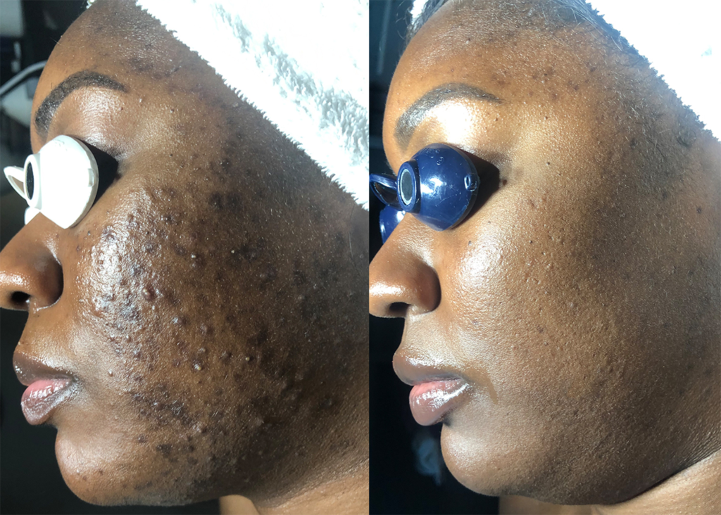 Acne Clearing: 4 3 Diamond Glow and 2 Chemical Peels