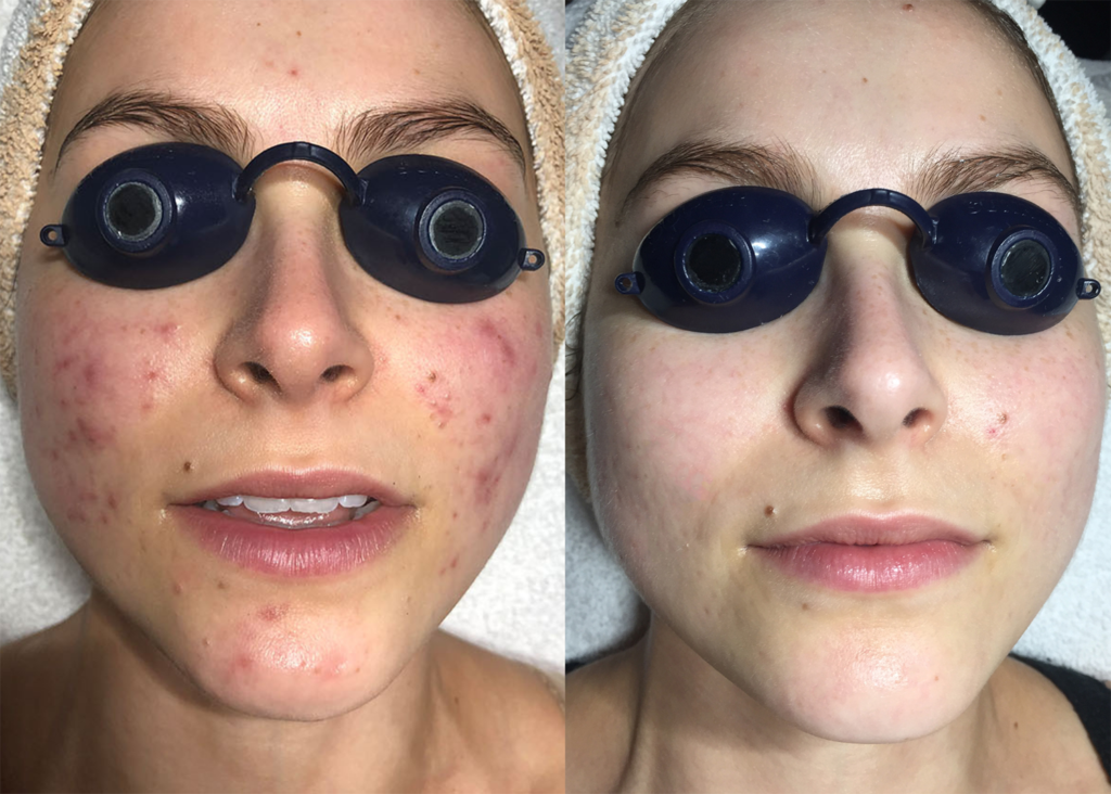 Acne Clearing + Pigment Correction (3 chemical peels )