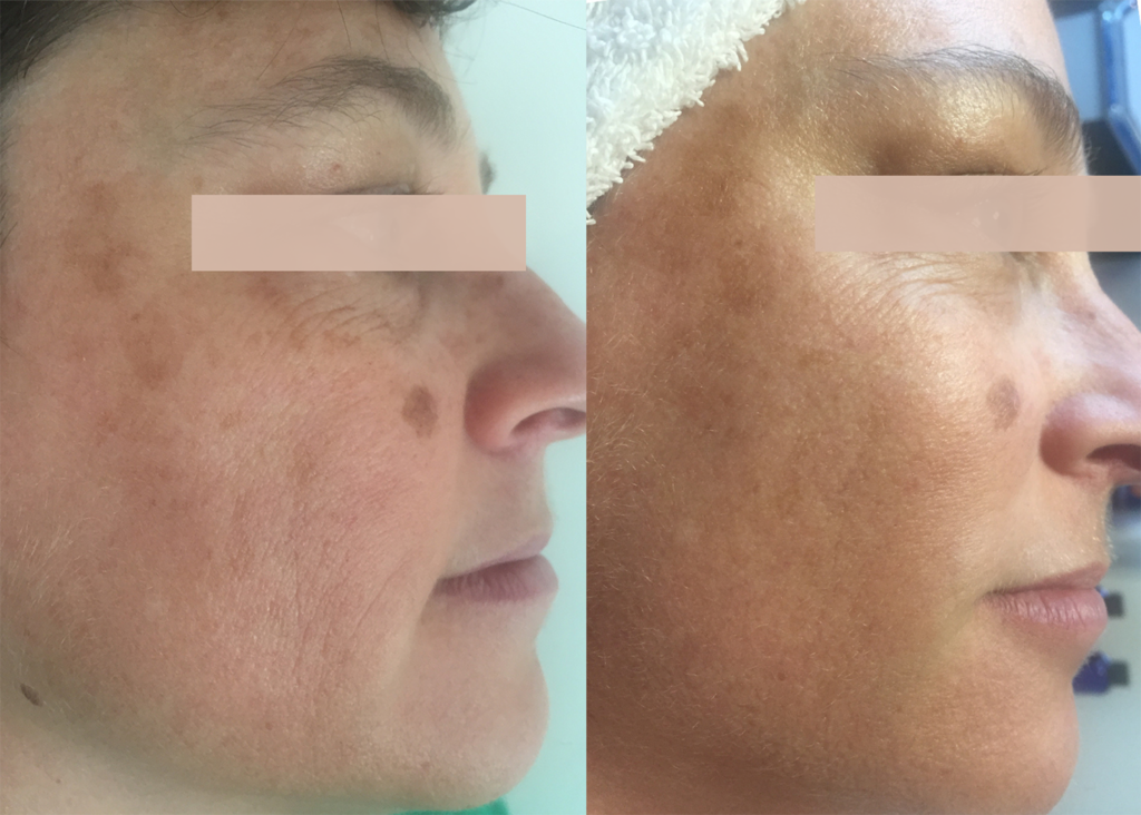 Age Repair - Microneedling + Diamond Glow