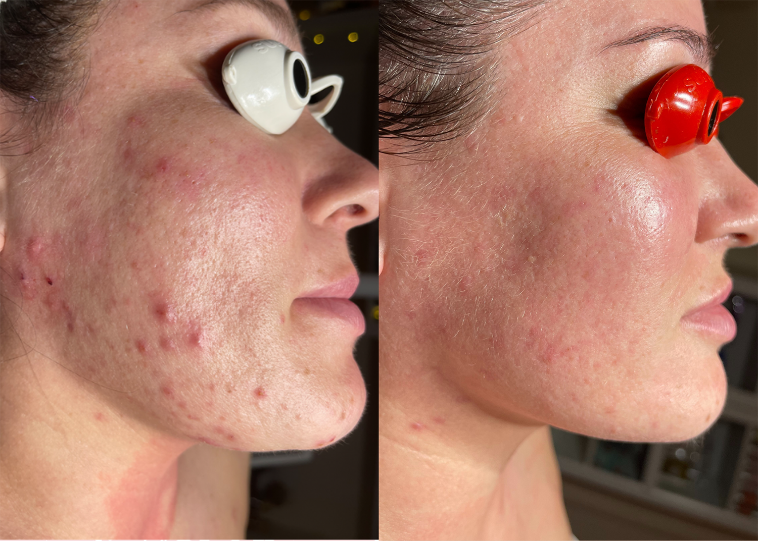 Beauty Bootcamp 4 Month Comprehensive Program: Acne Clearing