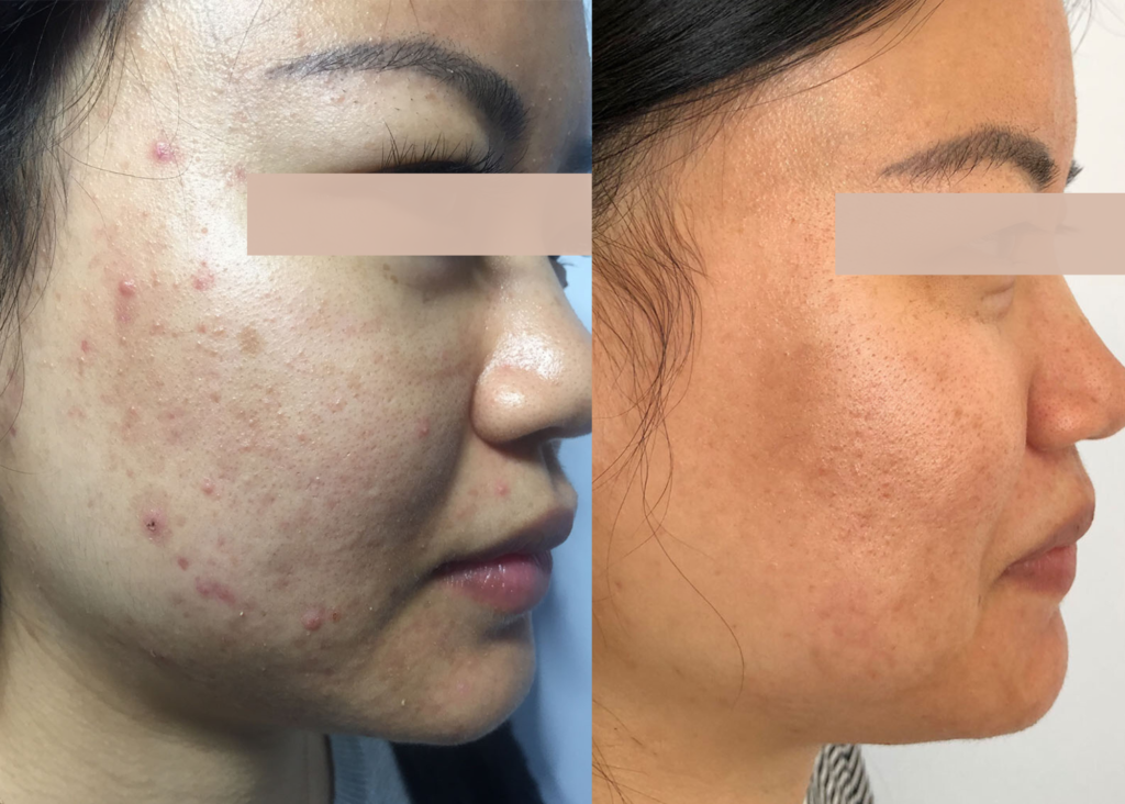 PHR Method - Beauty Bootcamp - 4 month comprehensive program- Acne Clearing + Pigment Correction (1)