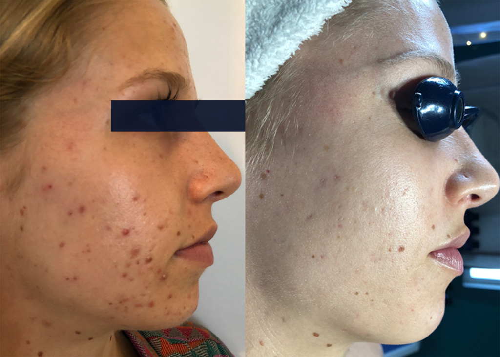 PHR Method - Beauty Bootcamp - 4 month comprehensive program- Acne Clearing + Pigment Correction