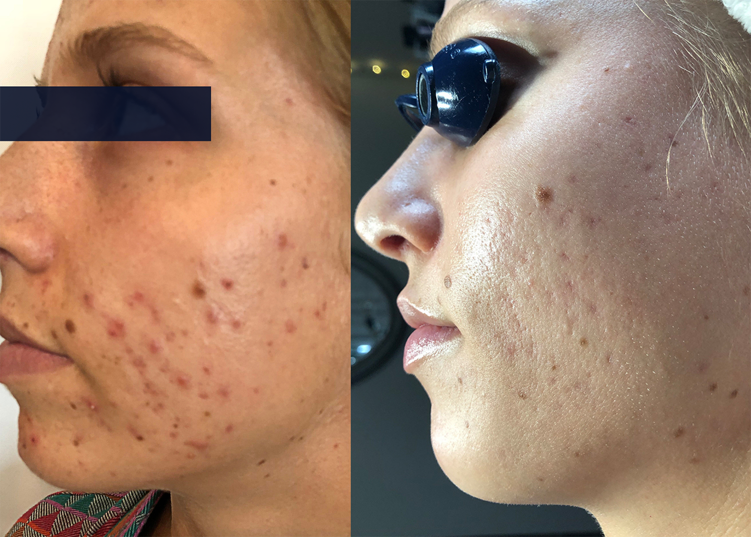 Beauty Bootcamp 4 Month Comprehensive Program: Acne Clearing + Scarring