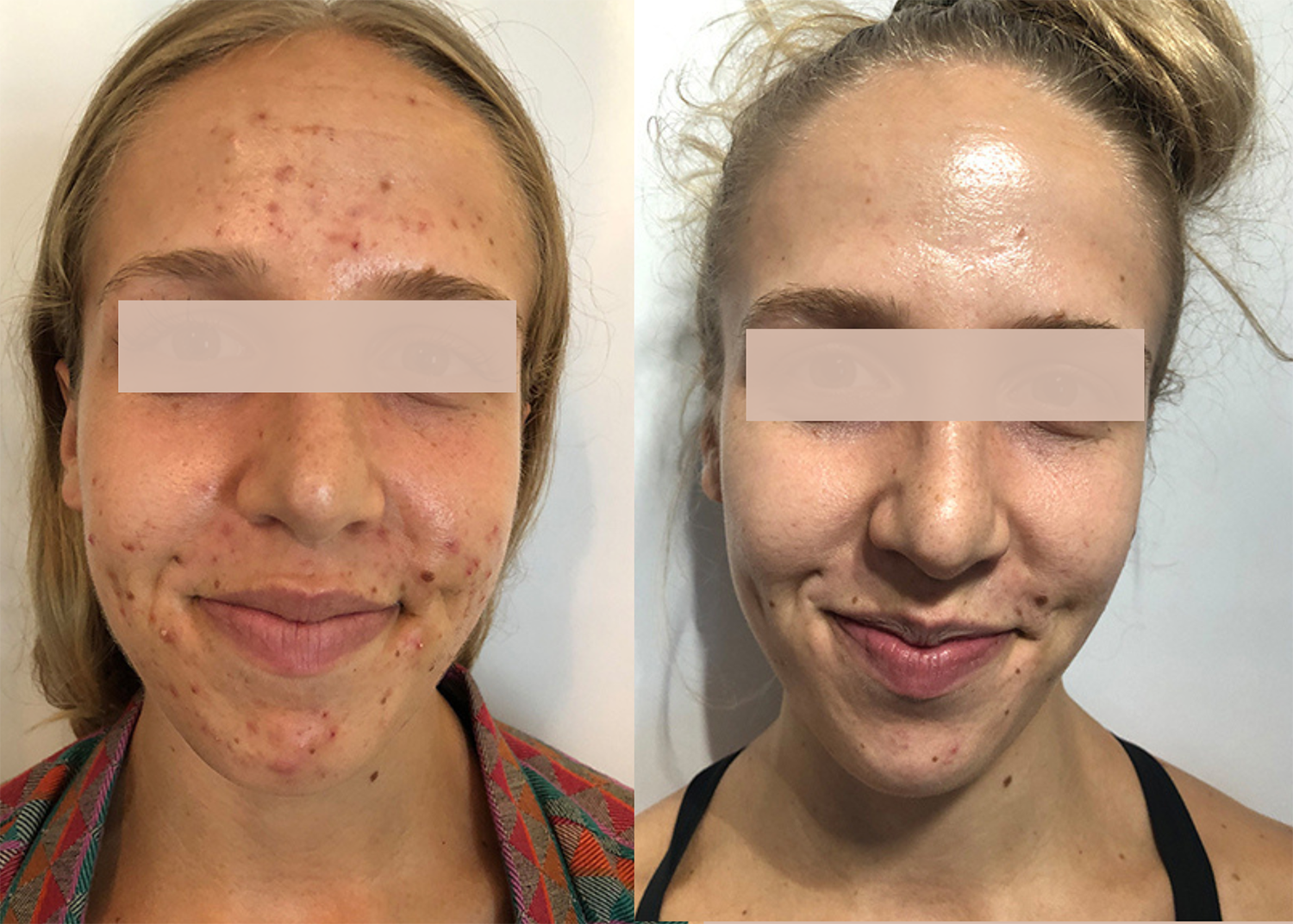 PHR Method - Beauty Bootcamp - 4 month comprehensive program- Acne Clearing + Pigment Correction (4)