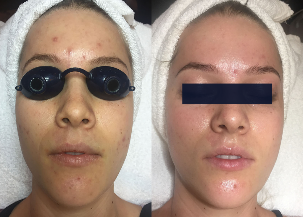 PHR Method - Beauty Bootcamp - 4 month comprehensive program - Acne Clearing + Rosacea + Lipid Barrier Repair