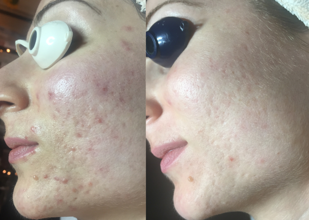 Beauty Bootcamp 4 Month Comprehensive Program: Acne Clearing + Scarring