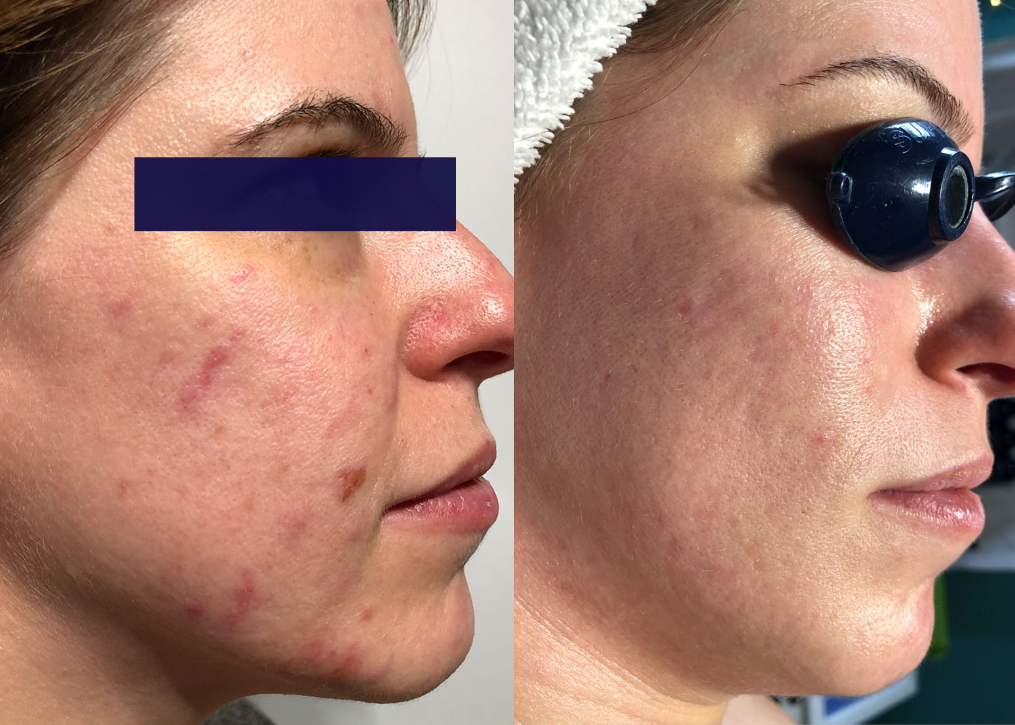 PHR Method - Beauty Bootcamp - 4 month comprehensive program- Acne Clearing + Scar Removal + Pigment Correction