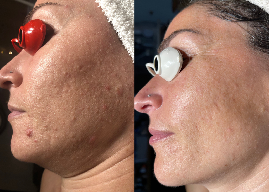 Beauty Bootcamp 4 Month Comprehensive Program: Acne Clearing