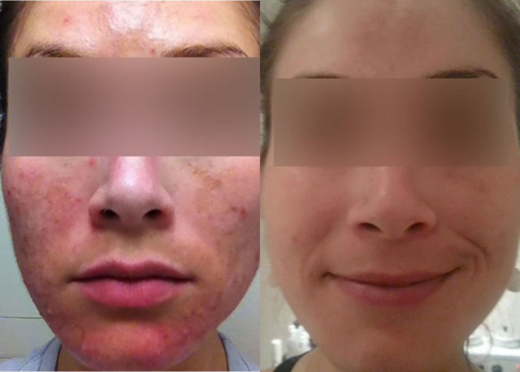 PHR Method - Beauty Bootcamp - 4 month comprehensive program- Pigment Correction + Acne Clearing (1)