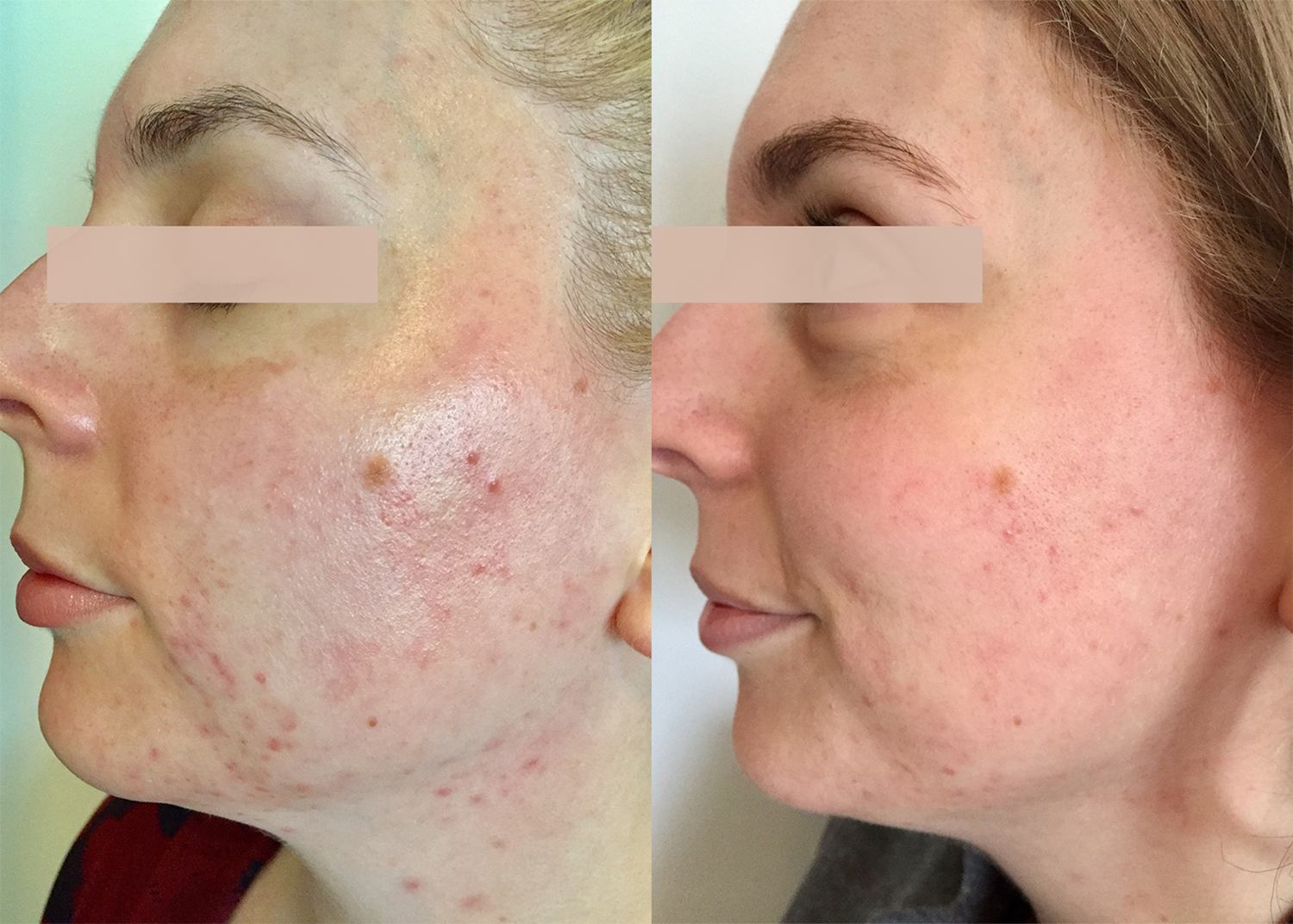 PHR Method - Beauty Bootcamp - 4 month comprehensive program- Pigment Correction + Acne Clearing (3)