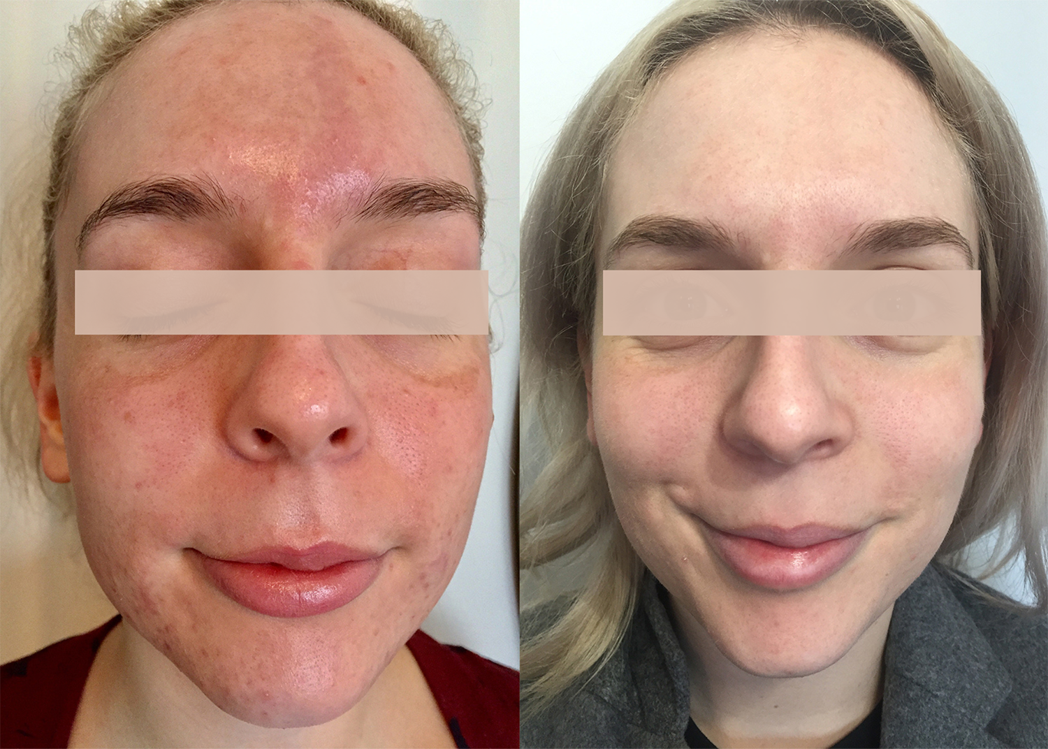 Beauty Bootcamp 4 Month Comprehensive Program: Pigment Correction + Acne Clearing