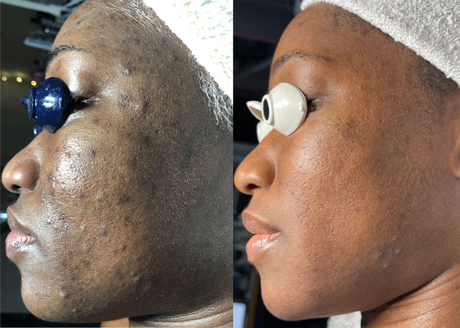 Acne Clearing + Pigment Correcting. (2 Diamond Glow + Chemical Peel boosts)