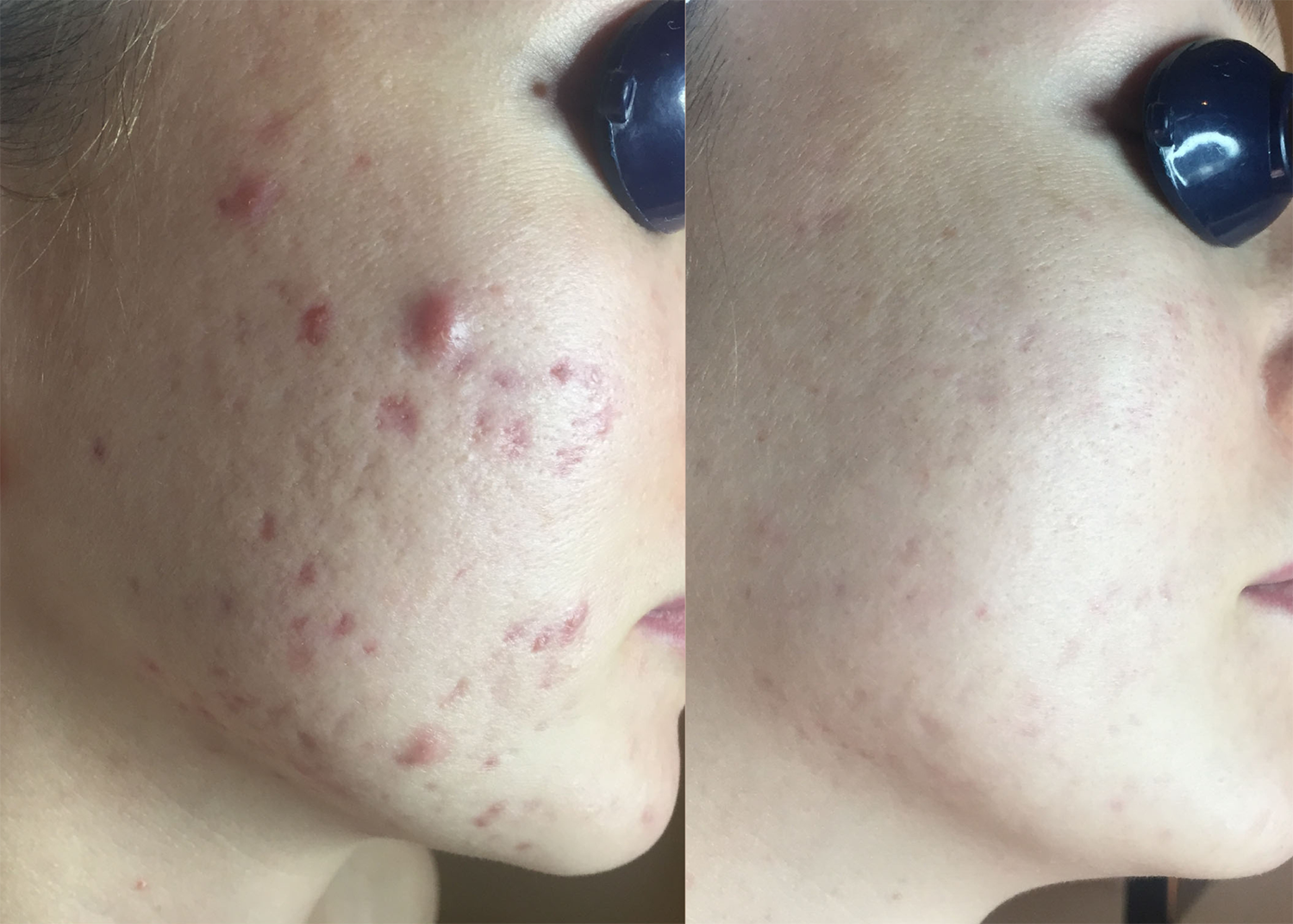 Acne Clearing + Scar Removal